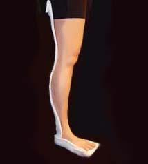 Lower Extremity Splints Long Leg Splint up to buttock crease Foot at 90 http://www.