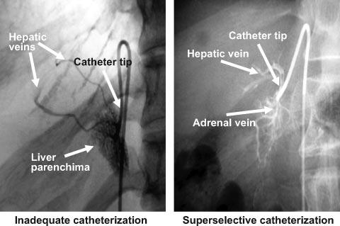 888 Hypertension October 2009 Selectivity Index 100 10 1 0.1 isolated right adrenal vein hepatic accessory veins P<0.05 P<0.