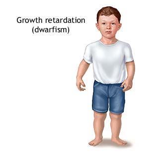 Growth Hormone Hyposecretion-Dwarfism
