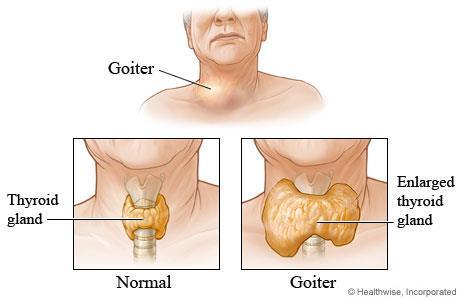 Goiter Enlarged thyroid gland caused by iodine deficiency Iodine