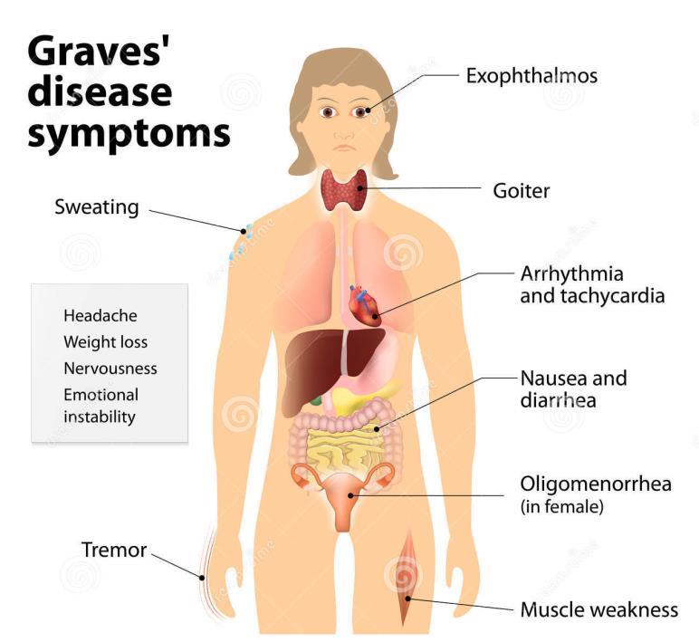 Graves Disease Autoimmune disorder that causes growth of thyroid and hypersecretion of thyroid hormones, with