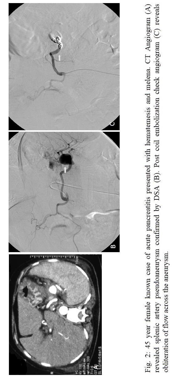 Attempted (n=30) 29(97%) 1 (3%) due to distal migration of coils in a case of splenic artery pseudo aneurysm Deferred (n=9) - - In 9 patients with pseudo aneurysms, therapeutic intervention was not