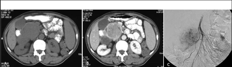 operation GIST (n=3) 2 Radiotherapy Recurrent myofibroblastic tumour of pancreas (n=1) 1 - PVA= Polyvinyl alcohol Figure 5:70 year male with malena.