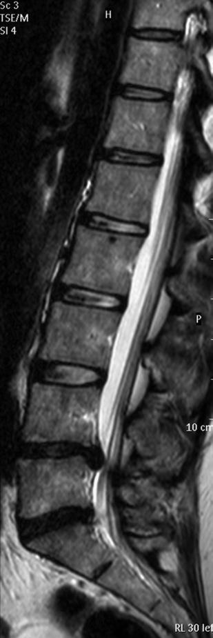 Following your recent MRI scan and consultation with your spinal surgeon, you have been diagnosed as having a lumbar disc protrusion, resulting in nerve root compression (trapped nerve) and leg pain
