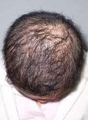 health. Starvation dieting, rapid weight loss and eating disorders often trigger some hair breakage or hair loss.