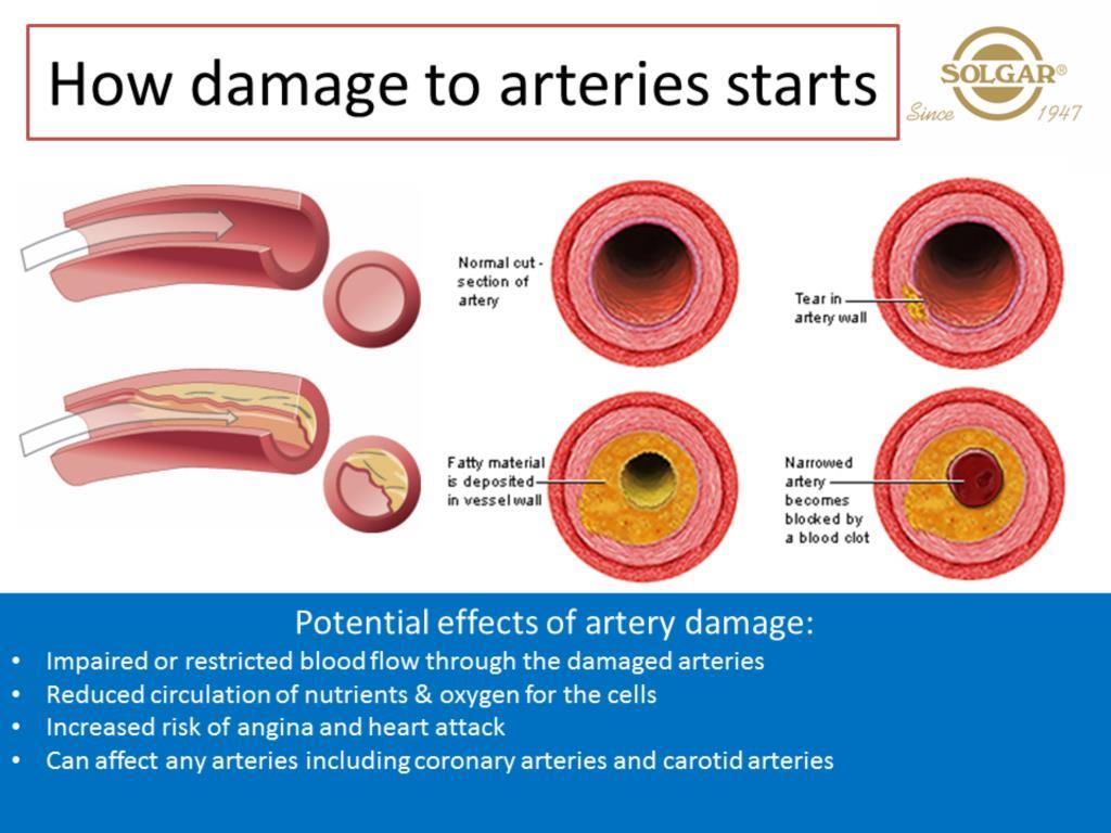 Cholesterol can become caught up on any tissue in the artery that is damaged or inflamed and adds to the narrowing of the artery as the deposit builds up.