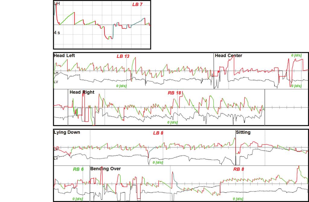 Lee H-J et al.: Pseudo-Spontaneous Nystagmus in Lateral Canal BPPV 203 Spontaneous Roll test Pitch test A Spontaneous Roll test Pitch test B Fig. 1.