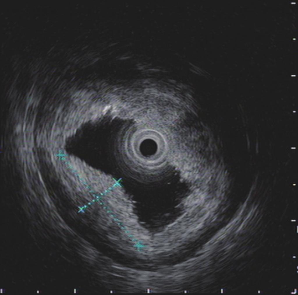 erosion and severe Figure 3 Endoscopic ultrasonography (EUS) showed middle and intestinal metaplasia and