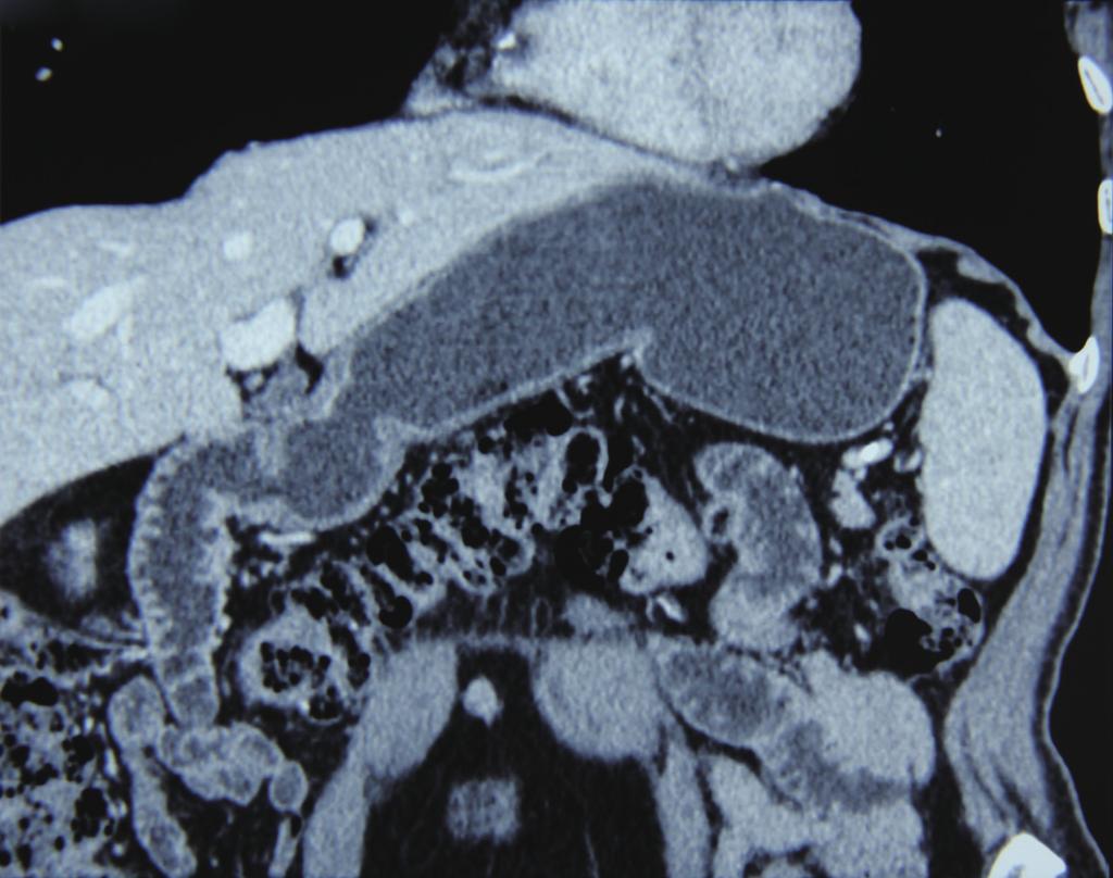 Three-dimensional reconstructive CT showed thickened and cancer cells seen in the bottom margin with a negative wall in gastric antrum and visible enlarged lymph nodes along circumferential margin