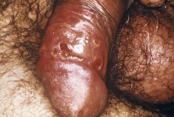 Early Syphilis: Primary Chancre painless develops 3 wks post exposure lymphadenopathy resolves 3-12 3 wks Early Syphilis: Secondary Rash