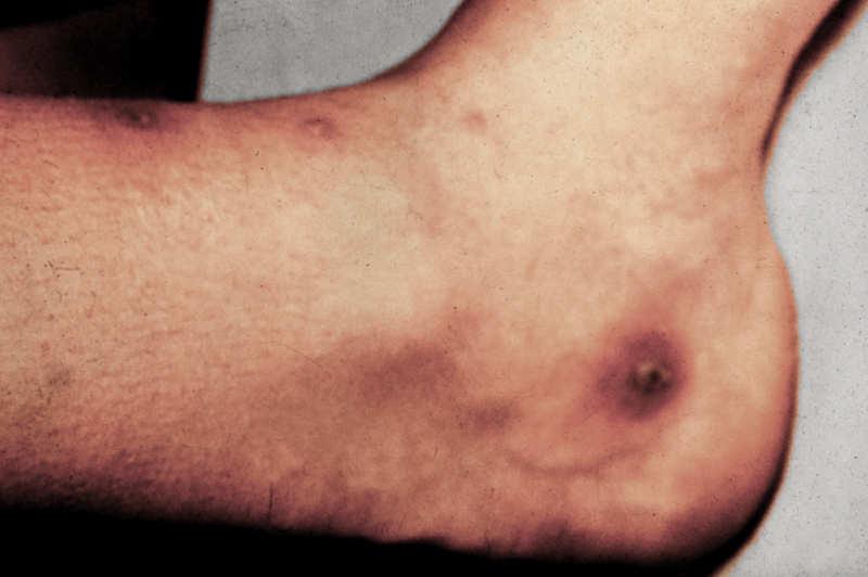 prior to dissemination Arthritis - Dermatitis Syndrome