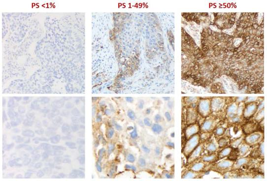 Examples of PD-L1 IHC