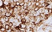 tumor and associated inflammatory cells or positive staining in stroma SCLC cohort: of 147 evaluable samples, 42 PD-L1 positive (28.