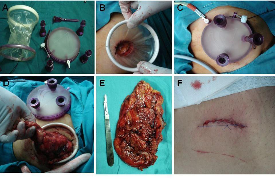 Laparoendoscopic Nephrectomy Aminsharifi et al (A) The GelPOINT system consistes of a wound retractor/protector (Alexis) and 4 multipurpose ports that accept 4.7 to 10 mm instruments.