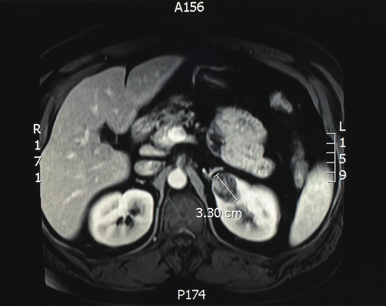 Page 2 of 5 Annals of Laparoscopic and Endoscopic Surgery, 2019 A B Renal mass Adrenal mass Figure 1 Pre-operative MRI and CT. (A) MRI of left upper portion renal mass; (B) CT of left adrenal mass.