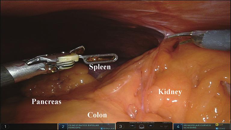 Annals of Laparoscopic and Endoscopic Surgery, 2019 Page 3 of 5 were minimal adhesions to the anterior wall. Three robotic trocars were placed, triangulated to access the left upper quadrant.