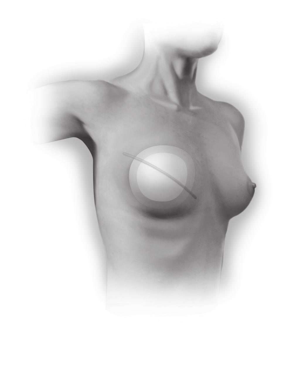 14 10647-03 What Is the Breast Implant Reconstruction Procedure?
