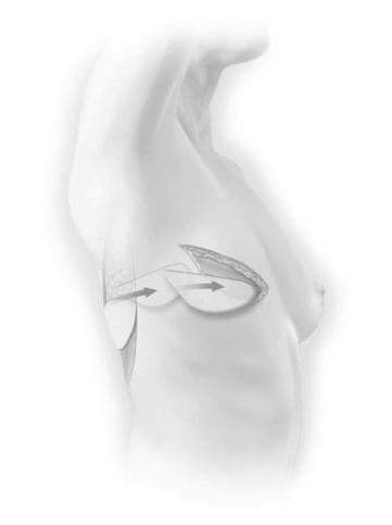 During a Latissimus Dorsi flap procedure, the surgeon moves a section of tissue from your back to your chest to reconstruct the breast.
