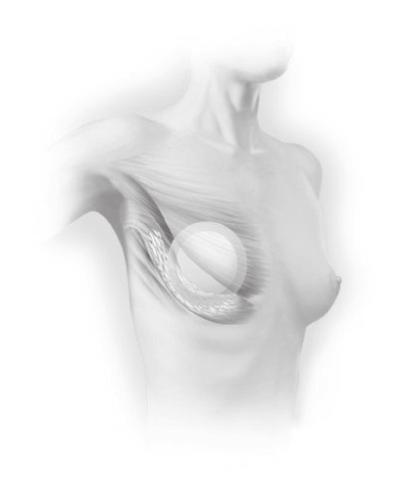 The Latissimus Dorsi flap procedure typically takes two to four hours of surgery under general anaesthesia. Typically, the hospital stay is two to three days.