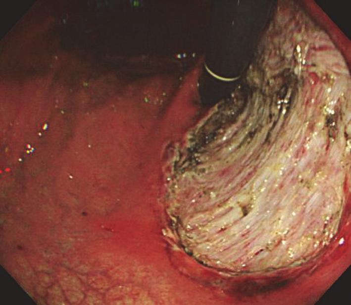 4 Figure 1: Case 1 underwent endoscopic submucosal dissection (ESD) for early gastric cancer in the upper