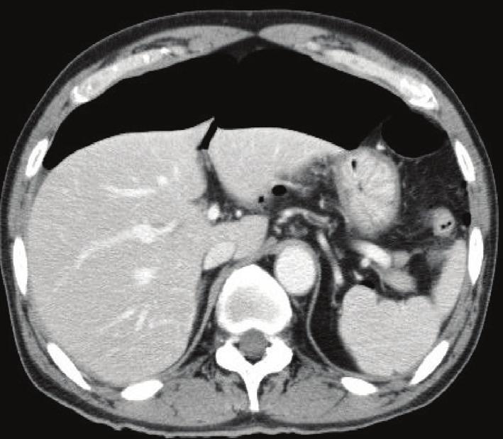5 4. Discussion Figure 7: Emergent CT shows massive free air when the patient complained of severe abdominal pain. stomach (Figure 5).
