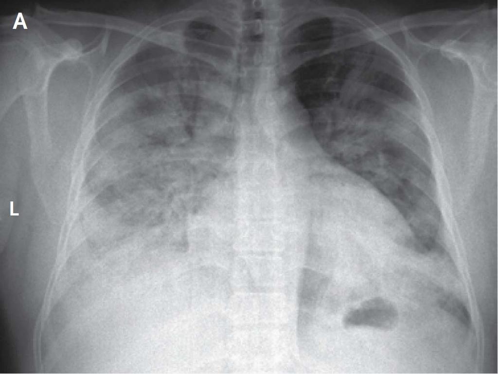Results: CXR findings No obvious finding: 8 (8.2%) 1 lung quadrants: 35 (35.