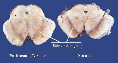 Parkinson Disease (PD) Usually idiopathic Substantia nigra degeneration causes