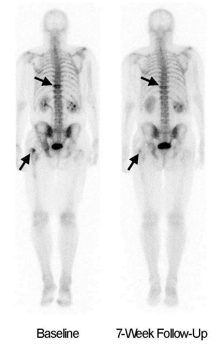 Cabozantinib Phase 1 Study: Activity Against Bone Metastases Clinical activity against metastatic lesions in bone was observed in some patients This scan shows partial bone resolution in a