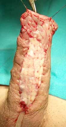 When harvest the graft from the cheek In patients with lichen sclerosus or failed hypospadias repair,
