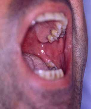 When harvest the graft from the tongue When the patient