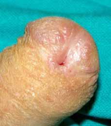 the second stage of urethroplasty,