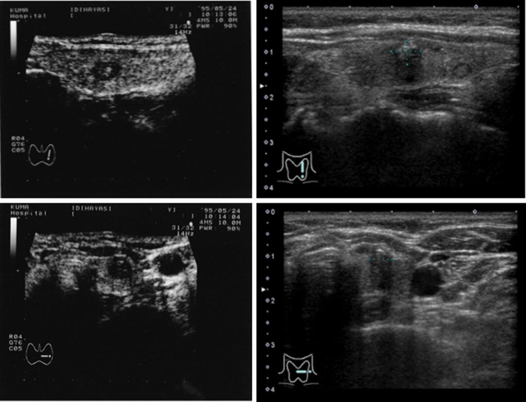 World J Surg (2016) 40:516 522 521 Fig. 4 Sonograms of a woman with papillary microcarcinoma at the presentation when she was 46-years old and those 18 years later.