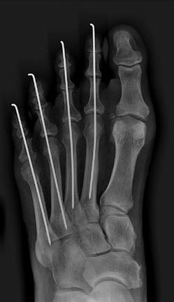 Procedure: The correction of the deformity requires resection of the contracted joint (knuckle) of the involved toe.