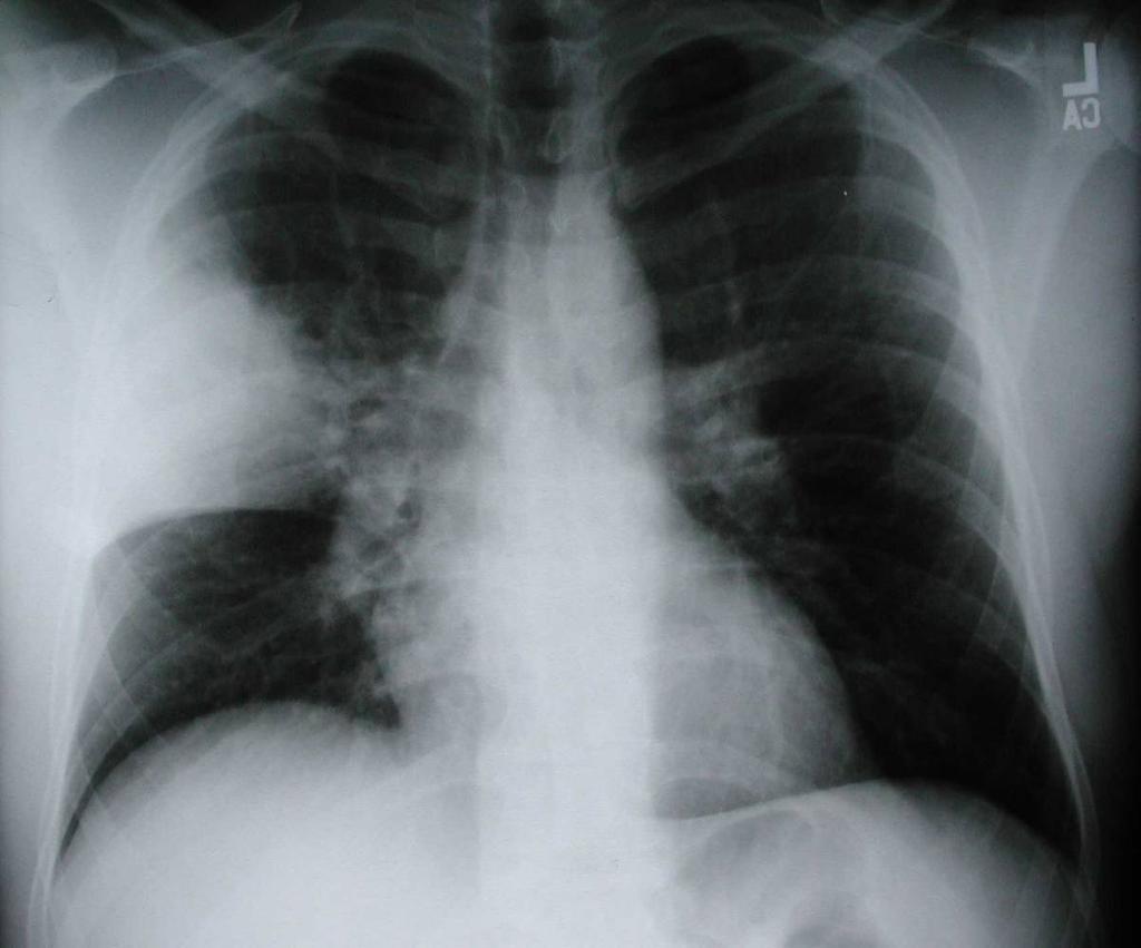 Incidence per 1,000 person-years * p<0.05 * 1. Bacterial pneumonia 2. COPD 3. PCP 4. Asthma 5. TB 6. Lung cancer 7. Pulmonary hypertension 8. Pulmonary fibrosis Crothers.