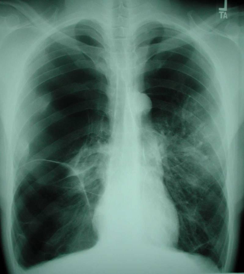Case 3 A. Bacterial pneumonia B. Pneumocystis pneumonia (PCP) C. COPD/emphysema D. Pulmonary Kaposi sarcoma (KS) E. Other 1.