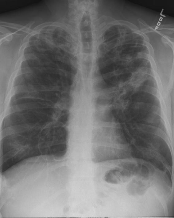 Case 5 A. Bacterial pneumonia B. Pneumocystis pneumonia (PCP) C. COPD/emphysema D. Pulmonary Kaposi sarcoma (KS) E.
