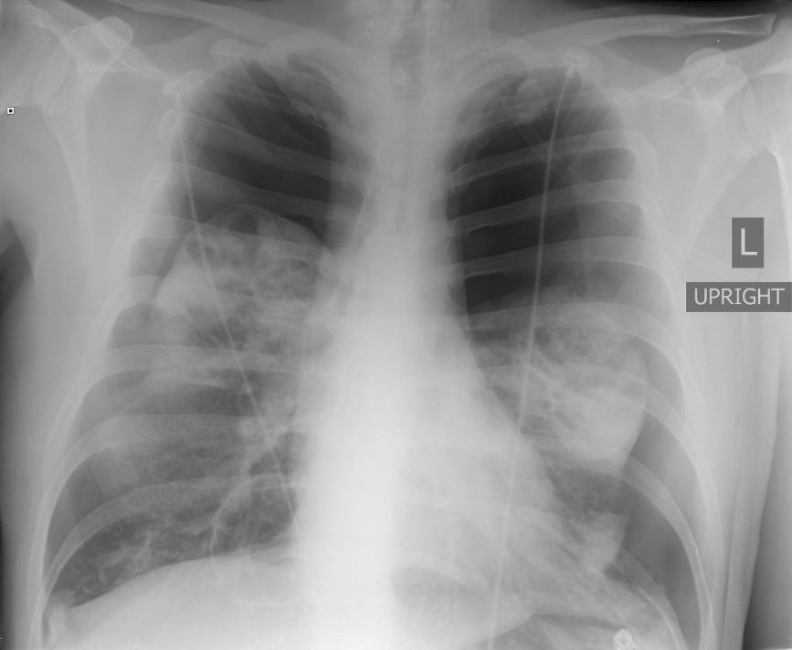 PCP is the most common HIV-associated opportunistic pneumonia that presents with pneumothorax 2.