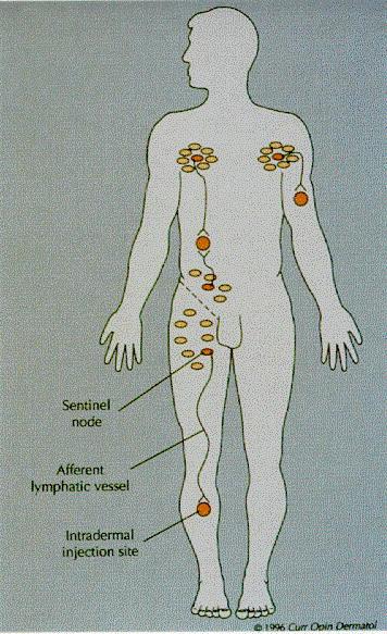 The Sentinel Lymph Node Lymphatic mapping: 1800s by Sappey SLN: 1977 by Cabanas Lymphatic mapping/sln: introduced by Morton 1992 Primary site
