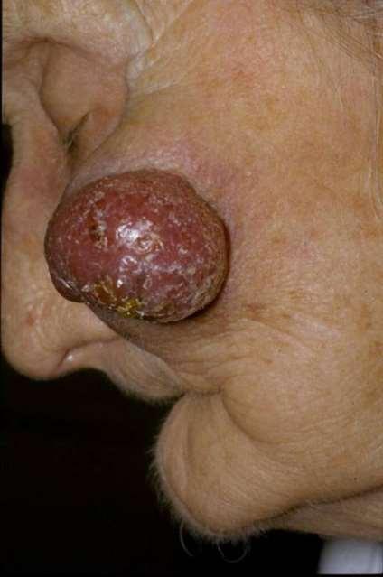 Merkel Cell Carcinoma Primary neuroendocrine skin tumor Derived from Merkel