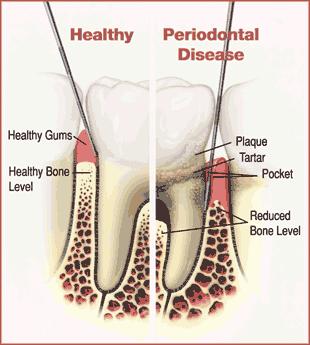 Periodontal Disease: A Quick Overview Periodontal disease is a chronic inflammatory disease that destroys the bone and gum tissues that support the teeth.