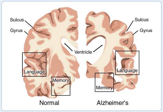 Alzheimer s Disease Alzheimer s disease is an inflammation of the brain. Antibodies and immune cells cross the blood brain barrier.