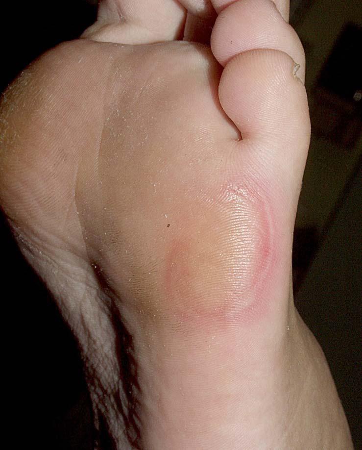 Hand-foot skin