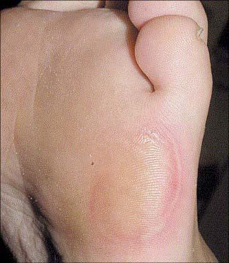treatment, Is dose dependent Sunitinib skin toxicity consisted of (A) painful periungual erythema, (B) bullous lesions on the
