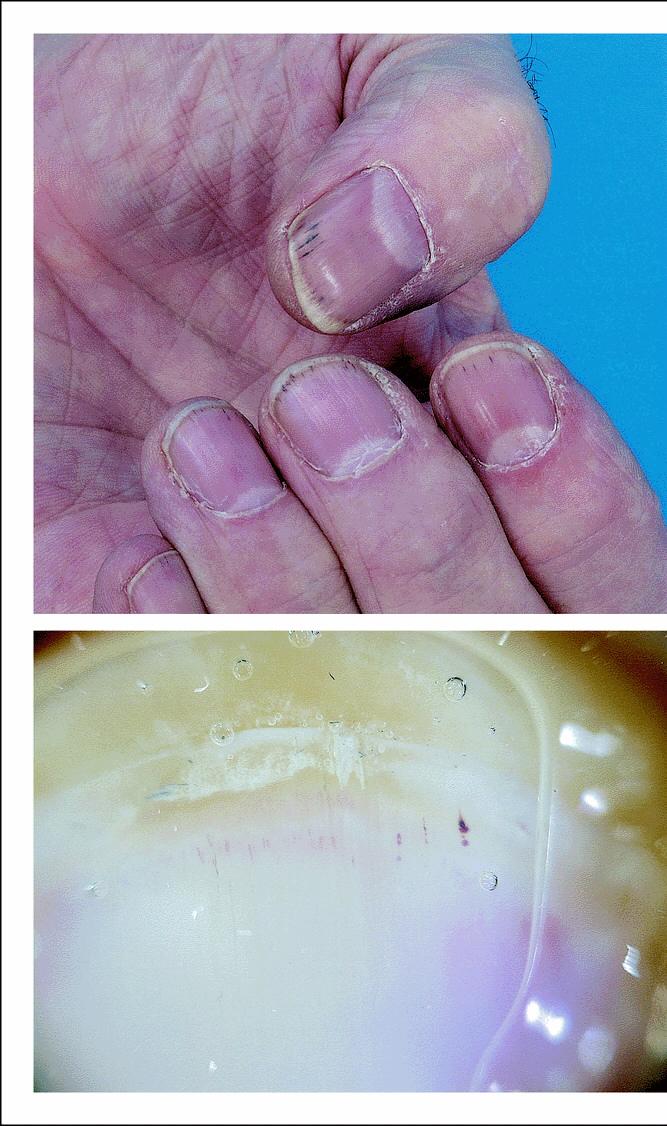 Subungual splinter hemorrhages VEGFR may be involved in the renewal of spiral capillaries that sustain frequent microinjuries at the extremities of the fingers.