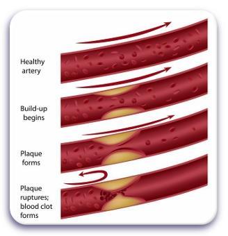 Primary Disease of the CV System Atherosclerosis The build up of plaque inside