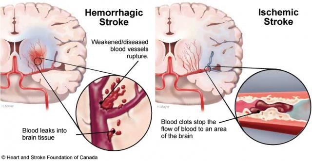 Stroke Occurs when the blood supply to the brain is