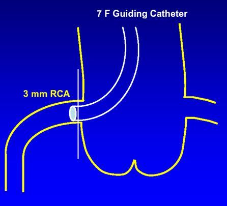 Possible Device Related Problems Compromising Pressure Measurement Guiding catheter