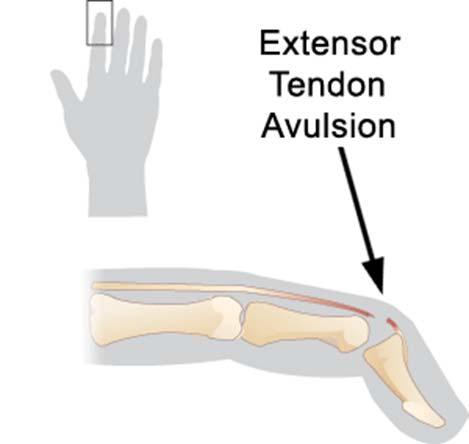 Spring 2014 EXSC 201 01 12 Mallet Finger avulsion of the extensor tendon of distal