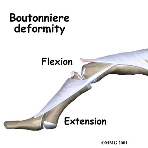 Spring 2014 EXSC 201 01 17 Boutonnière Deformity avulsion of the extensor tendon over the middle phalanx which