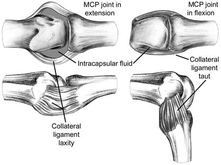 Spring 2014 EXSC 201 01 4 Collateral Ligaments (MCP joints) looser in